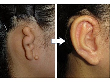 赤ちゃん 子どもの耳あかは 取らないで 耳掃除よりスキンケアが大切 小児科医 たまひよ