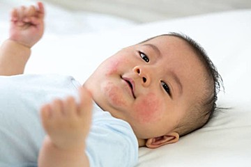 赤ちゃんの皮膚の病気 乳児湿疹 乳児脂漏性湿疹の症状とケア 医師監修 たまひよ