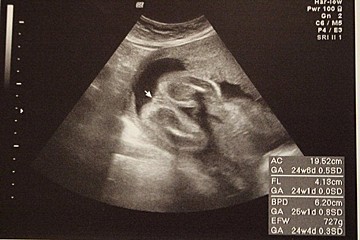 妊娠週 赤ちゃんのエコー写真 超音波写真まとめ たまひよ