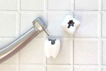 【歯科医が教える事実】実は〇〇の隣の歯が虫歯になることが非常に多い！