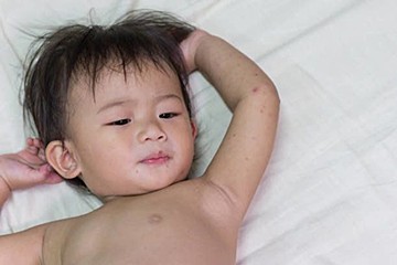 赤ちゃんの感染症 溶連菌感染症の症状とケア 医師監修 たまひよ